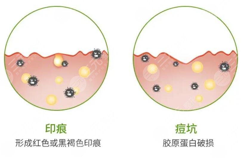 复合彩光祛痘的案例介绍