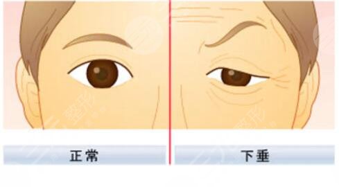 上眼皮下垂手术