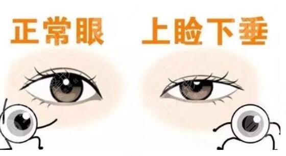 上眼皮下垂手术能保持多久？