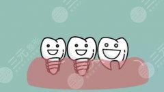 种植牙齿从开始到结束要多久？牙齿种植技术原理get！