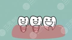 种植牙齿从开始到结束要多久？牙齿种植技术原理get！