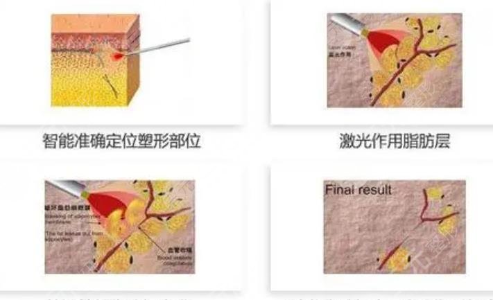 等离子激光溶脂