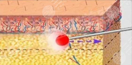 等离子激光溶脂