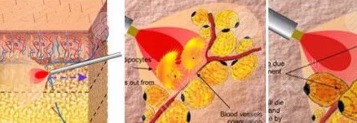 等离子激光溶脂