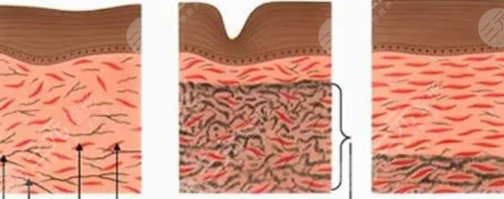 等离子激光溶脂