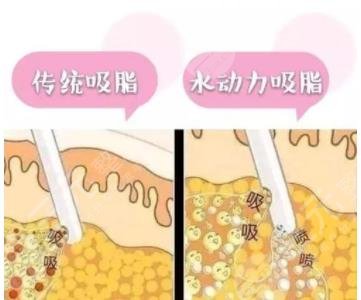 水动力吸脂