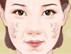 老年斑的形成原因有哪些？做斑点去除手术前后注意事项分享！