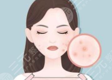 如何缓解青春痘粉刺？痤疮生长的原因是什么？注意事项介绍