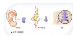 假体隆鼻果好不好?做鼻整形必看科普!术后注意事项一览~ 假体隆鼻果好不好?做鼻整形必看科普!术后注意事项一览~