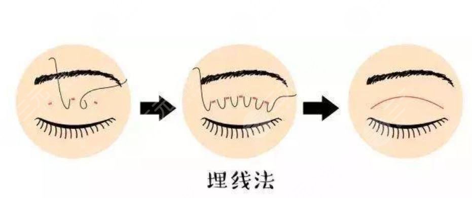 双眼皮