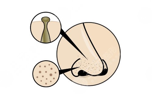 如何去鼻子上的黑头?