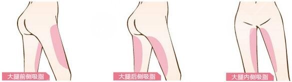 腿部吸脂需要多少钱一般?