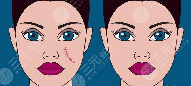 缓解疤痕好的方法有哪些？这3种方法目前来看果！看看哪种适合你？