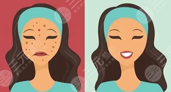 痘印产生的原因