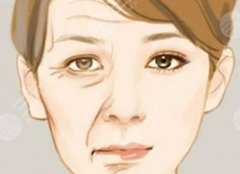 天生鱼尾纹能祛除吗？自体填充和激光除皱PK，你来挑选！