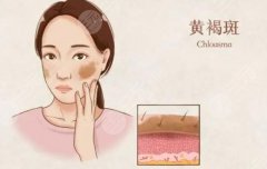 晒斑和黄褐斑的区别图解！不想当“斑花”，这篇科普必看~