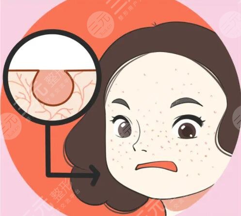3,激光治疗毛孔粗大术后怎样护理皮肤?