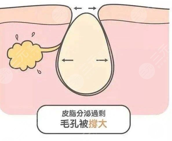什么医美项目收缩毛孔果好？近几年爆款医美项目云集，总有一款适合你~