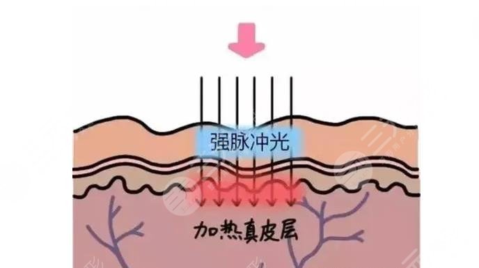 皮肤暗黄可以做光子嫩肤技术吗?