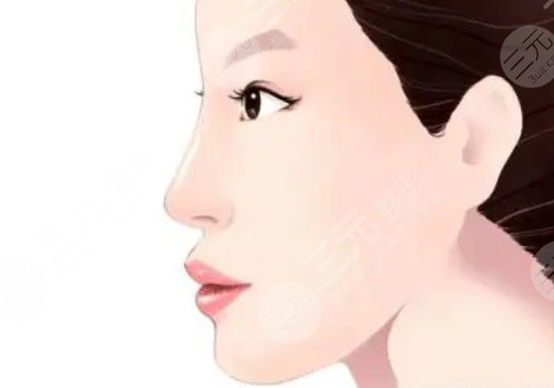 耳软骨隆鼻的恢复期是多久?