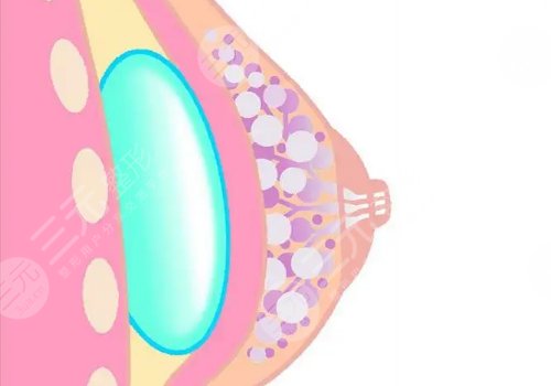 假体隆胸一次可以增大几个罩杯?