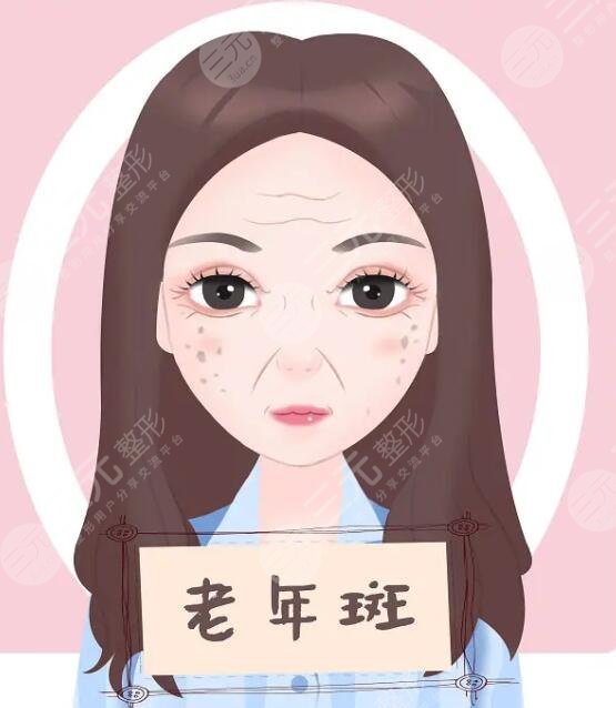 长老年斑吃什么好?老年斑是每一个中老年朋友的天敌,而随着年龄的增长,老年斑也是大多数人不可避免的一个困扰,但是在现实生活中,通过一些方式可以很好的避免老年班,除了做一些新型的医美项目,去除老年斑以外,通过一些口服方式也可以有去除老年斑,下面不妨跟着小编一起来了解一下,究竟长老年斑吃什么好。希望可以帮助到更多有老年斑的爱美人士们。 1、长老年斑吃什么好? 当皮肤长老年斑的时候,可以通过吃一些食物或者是吃一些药物来改良。 (1)食物 日常生活中可以适当的多吃一些富含维生素C和维生素E丰富的食物,这些食物不但可以预防老年斑形成,另外还可以减缓老年斑。生活中常见的富含维生素C的食物主要有西红柿、苹果、胡萝卜、猕猴桃以及香蕉等,富含维生素E的食物主要有香蕉、鱼油以及鱼肝油等。身体摄入足量的维生素c和维生素e可以阻止皮肤内的黑色素形成,可以加快皮肤新陈代谢,有助于降低黑色素在身体内沉积,对缓解老年斑具有不错的果。 (2)药物 皮肤长老年斑的时候,可以在专业医生指导下口服维生素E软胶囊或者是维生素C片,可以起到延缓老年斑的果,一般情况下不可以彻底去除老年斑。 2、老年斑是怎样形成的? 老年斑的形成大多与日晒、皮肤老化以及遗传等多方面原因有关系。老年斑属于皮肤退行性改变,随着年龄增长,皮肤会逐渐出现老化,在皮肤的表面上就会出现一些色素斑片,表面通常是光滑的,颜色是棕褐色,大多发生在皮肤暴露的部位,例如手背和面部。老年斑并不会影响到身体健康,但如果影响到了个人的美观,可以通过一些医美项目去除。 3、怎样去除老年斑? (1)光子嫩肤 光子嫩肤是一种新型医美项目,主要通过仪器发出的特定波长,穿透皮肤表皮层,具有选择性地照射在皮肤基底层,可以将皮肤基底层的色素细胞快速分解,被分解的色素细胞会随着身体的新陈代谢和淋巴系统逐渐排出体外。做完光子嫩肤以后一定要做好皮肤防晒措施,外出的时候可以佩戴遮阳帽或者打遮阳伞,尽量不要擦防晒霜,避免皮肤出现色素沉着的现象,另外饮食也要以清淡为主,不要吃黑色素太重的食物,也不要吃辛辣刺激的食物。 (2)注射美白 注射美白的主要成分是美白因子,采用一次性注射器,将美白成分注射在皮肤内,可以抑制皮肤内的黑色素形成,从而让皮肤变得更加美白,也可以起到去除老年斑的果。注射美白不会给皮肤造成太大的创伤,只会留下几个细微针孔,大约3天到5天左右,注射一次大约可以维持半年左右。