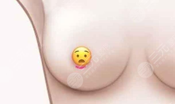 假体丰胸材料哪些好用?