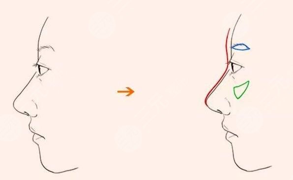 真性假性金鱼眼