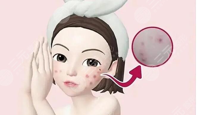 光动力激光缓解痤疮术后注意事项