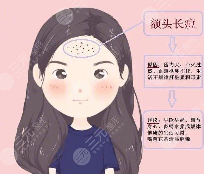 光动力激光缓解痤疮术后注意事项
