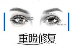 双眼皮做宽了能修复吗？科普眼整形失败应该怎么办！