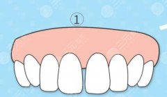 牙缝很大怎么办？牙齿贴面技术有用吗？术后如何护理？