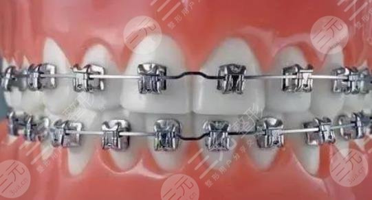牙齿矫正