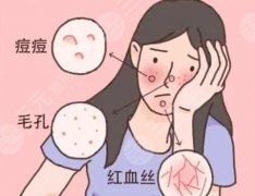 激光能去除红血丝吗？会反弹吗？效果怎么样？