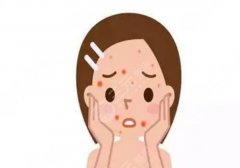 茶叶水去痘印是真的吗？快速祛除痘印方法？