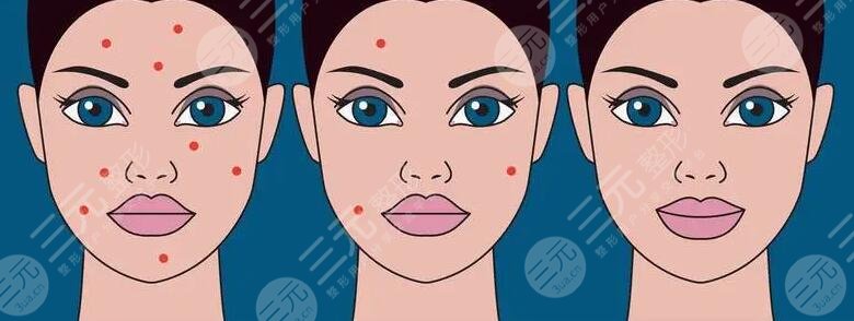 复合彩光祛痘的原理是什么?