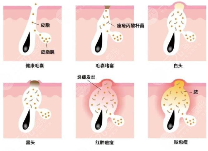 复合彩光祛痘需要多少钱?