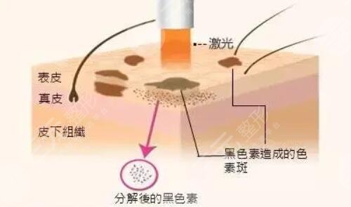 e光祛斑的工作原理是什么?