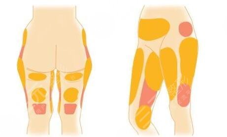 大腿吸脂手术