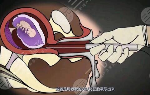 人流手术具体是怎么操作的?