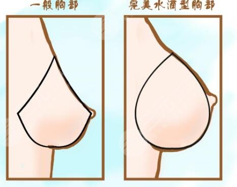 英国娜高假体的优势性