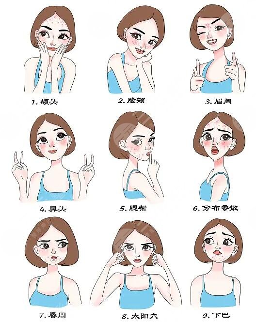 痤疮怎么治才能彻底?