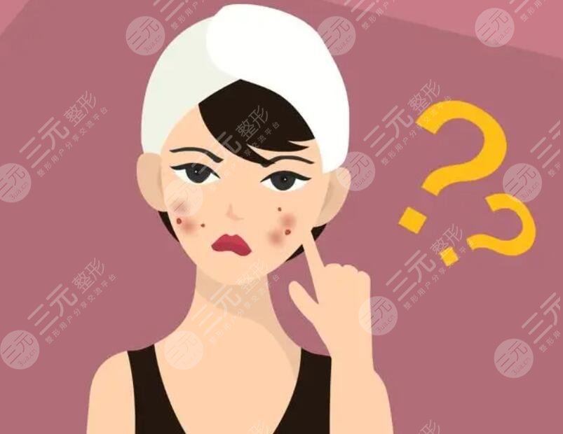 痤疮怎么治才能彻底?