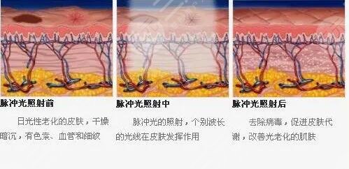 光子嫩肤的功是什么?