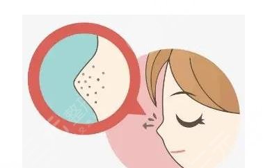 黑头导出液真的有用吗?