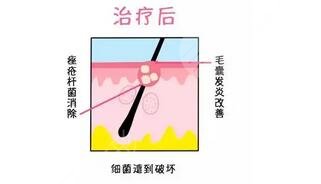 红光缓解痤疮几次见?