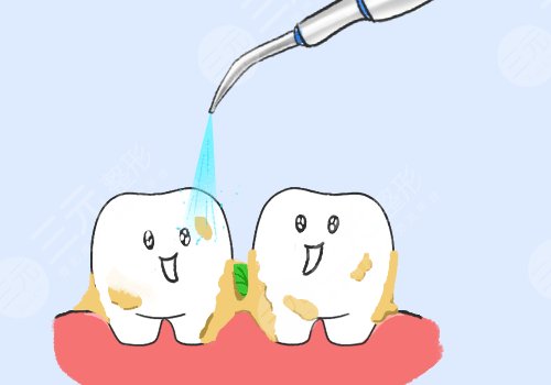 正常洗牙要多少钱一次?