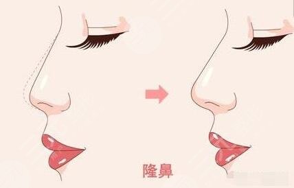 达拉斯隆鼻的优势性