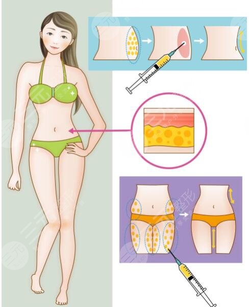 等离子激光溶脂有危害吗?对身体有伤害吗?副作用是什么?怎么果?