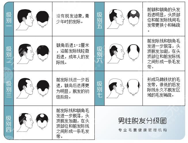 脱发1-7级程度图片男女对比，看看你修炼到几级了？脱发原因大揭秘！